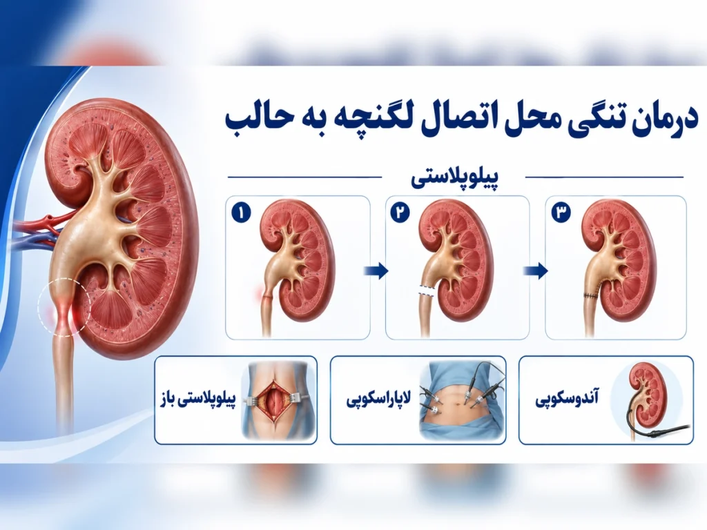 درمان تنگی محل اتصال لگنچه به حالب